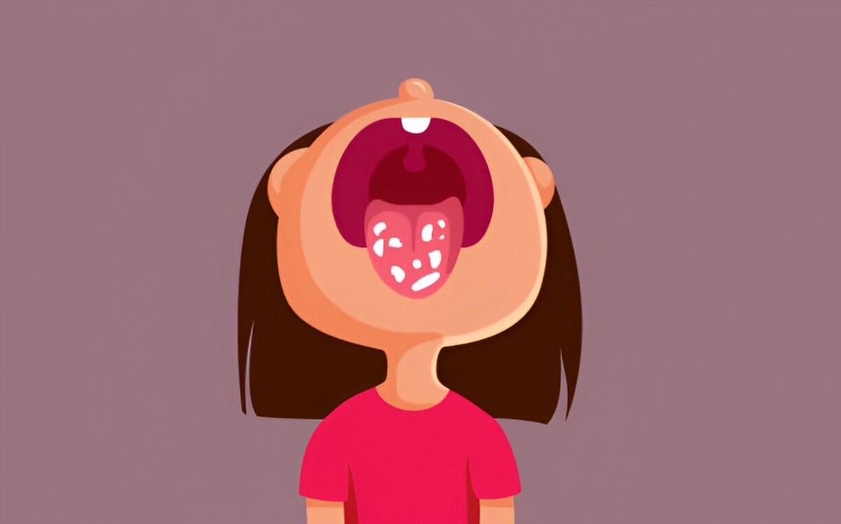 Thrush on the Tongue