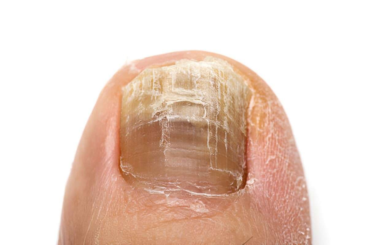 Toenail Fungus