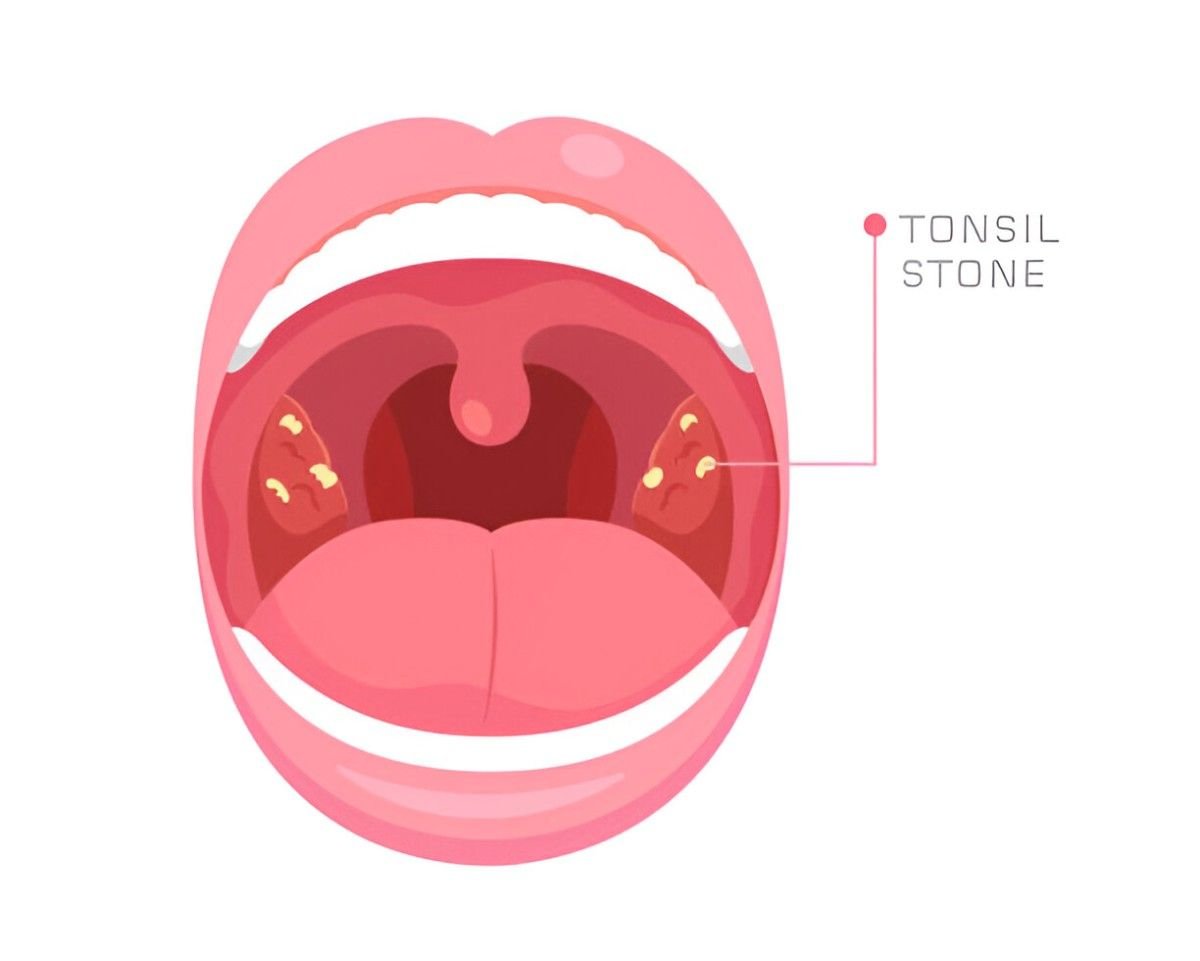 Tonsil Stones